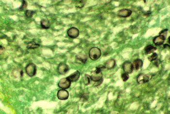 Image: Pneumocystis pneumonia (PCP) or pneumocystosis is a form of pneumonia caused by the fungus Pneumocystis jirovecii (Photo courtesy of the CDC).